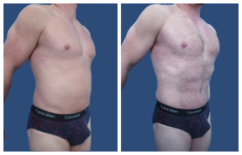 Liposuction of the Belly right Oblique View.