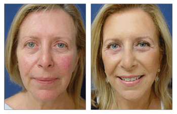Liposuction of the face before and after view.