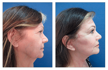 Liposuction of the neck and facelift provide the best profile improvements.