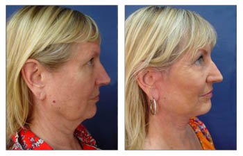 Side-by-side profile photos of a middle-aged client demonstrating a before and after view of liposuction of the neck.
