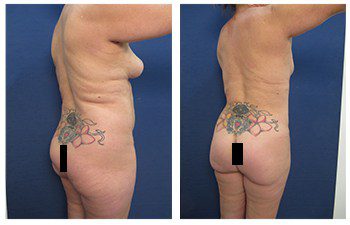 Liposuction of the thighs before and after.