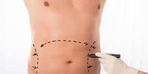Male Liposuction front view