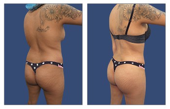 High definition liposuction of the lowerback, flanks, lateral thighs, with fat grafting to the buttocks, and abdominoplasty with muscle plication.