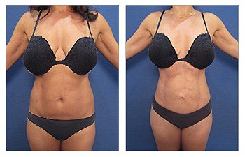 Abdominal Etching 21 Abdominal Etching 21
