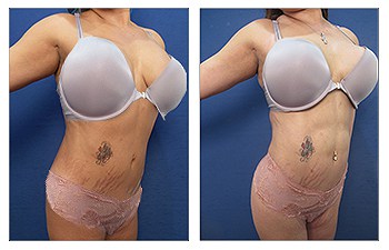Abdominal Etching 31 Abdominal Etching 31