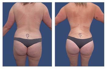 BBL 7 BGOK (1) high-definition VASER liposuction of flanks, lower back, lateral thighs, BBL, abdominoplasty with muscle plication, and breast lift.