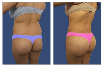 BBL 9 BGOK buttock augmentation with implants, and a BBL