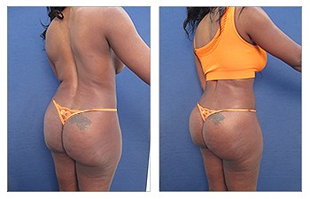 High definition liposuction of the abdomen, flanks, lower back, middle back, upper back, lower back, lateral thighs, and BBL, and Renuvion of the upper, middle, lower back, flanks, medial thighs, abdominoplasty with muscle plication, labia minora tucking.