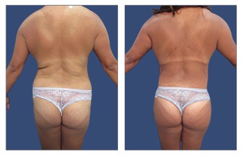 Back Contouring 8 BGOK High definition liposuction of the flanks, lower back, middle back, upper back, medial thighs, lateral thighs, extended abdominoplasty with lateral thigh tuck, buttocks and breast fat grafting.