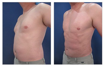 High definition liposuction with VASER of the flanks, lower back, abdomen, mini tummy tuck, chest masculinization, neck liposuction, Renuvion of the love handles and neck.