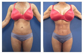 HD VASER lipo of flanks, lower back, abdomen, mini TT, lower body lift, fat grafting to buttocks