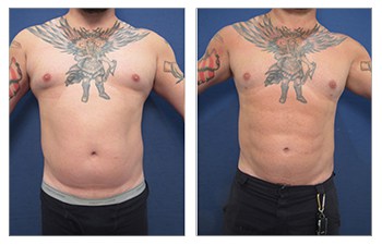 HD VASER lipo of abdomen, flanks, chest, lower back, fat grafting and sculpting of chest
