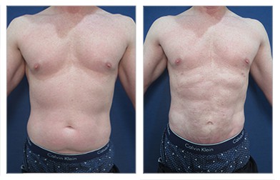 High definition liposuction of the abdomen, chest(gynecomastia), flanks, lower back, with fat grafting of the chest and buttocks, and pubic and lower abdominal skin excision.