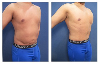 HD VASER lipo of flanks, abdomen, chest masculinization, MASR