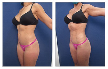 Waistline 17 High definition liposuction of the flanks, lower back, middle back, upper back, abdomen, medial thighs, pubic skin resection, buttocks fat grafting, bilateral breast implant removal, capsulotomies, capsulectomies, and implant replacement and breast lift, Renuvion of the upper back, middle back, lower back, flanks, medial thighs.