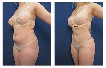High definition liposuction of the abdomen, lateral chest, flanks, medial thighs, lateral thighs, back, and fat grafting to the buttocks.