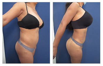 Mini TT, HDVL flanks, lower/middle/upper back, fat grafting to breasts and buttocks, renuvion of flanks, lower/middle/upper back