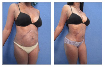 Flanks Lipo - High Definition Flank Liposuction