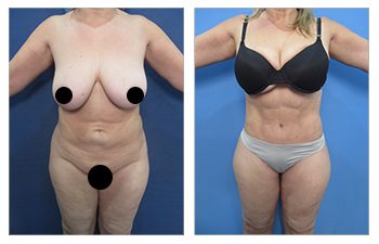 Before and after comparison of a woman's physique including a designer belly button after tummy tuck.