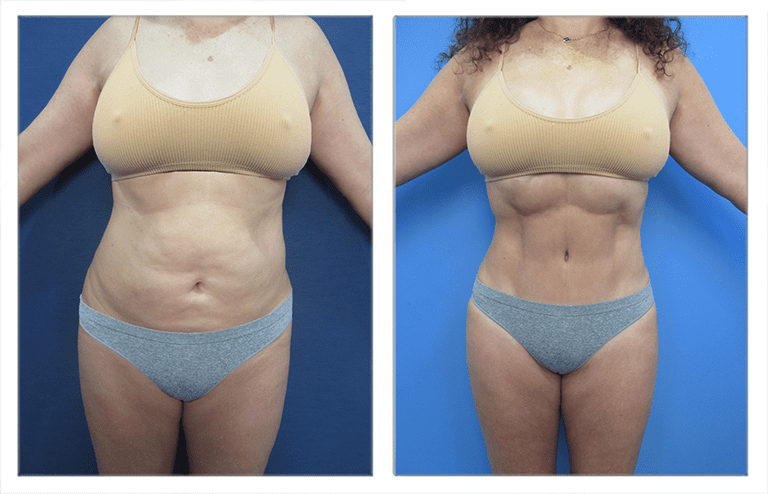 Before and after comparison of a woman's abdomen following high defintion liposuction and tummy tuck, featuring an expertly crafted designer belly button.