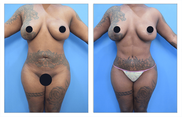 Before and after comparison of a body with designer belly button during your tummy tuck