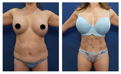 Before and after comparison of a woman wearing a bikini, following tummy tuck to correct Fatty Upper Pubic Area.