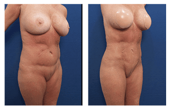 Before and after comparison of abdominal surgery focusing on the Fatty Upper Pubic Area.