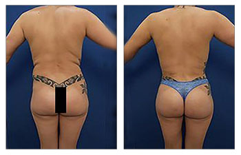 A 29-year-old female following VASER Liposuction of the medial thighs, lateral thighs, back, flanks, as-well-as a Brazilian Buttocks Lift and Reuvion skin tightening. The patient demonstrates ideal buttock shape.