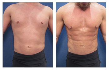 Ab Etching with HD VASER Liposuction of chest, lower back, flanks, abdomen, fat grafting to buttocks and chest