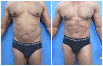 Ab etching with VASER Liposuction and High Defintion Tummy Tuck