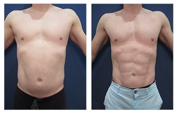 Abdominal Etching following Hi-Def VASER Lipo of abdomen, lateral chest, flanks, back, fat grafting to chest
