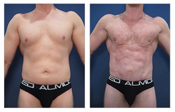 Abdominal Etching with Hi-Def VASER lipo of chest, lower back, flanks, abdomen, fat grafting to buttock, chest, and mini tummy tuck