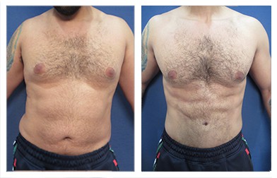 Abdominal Etching wtih High Definition VASER liposuction and Renuvion of flanks, lower back, male buttock masculinization with fat grafting, chest masculinization, modified abdominal skin resection (MASR)