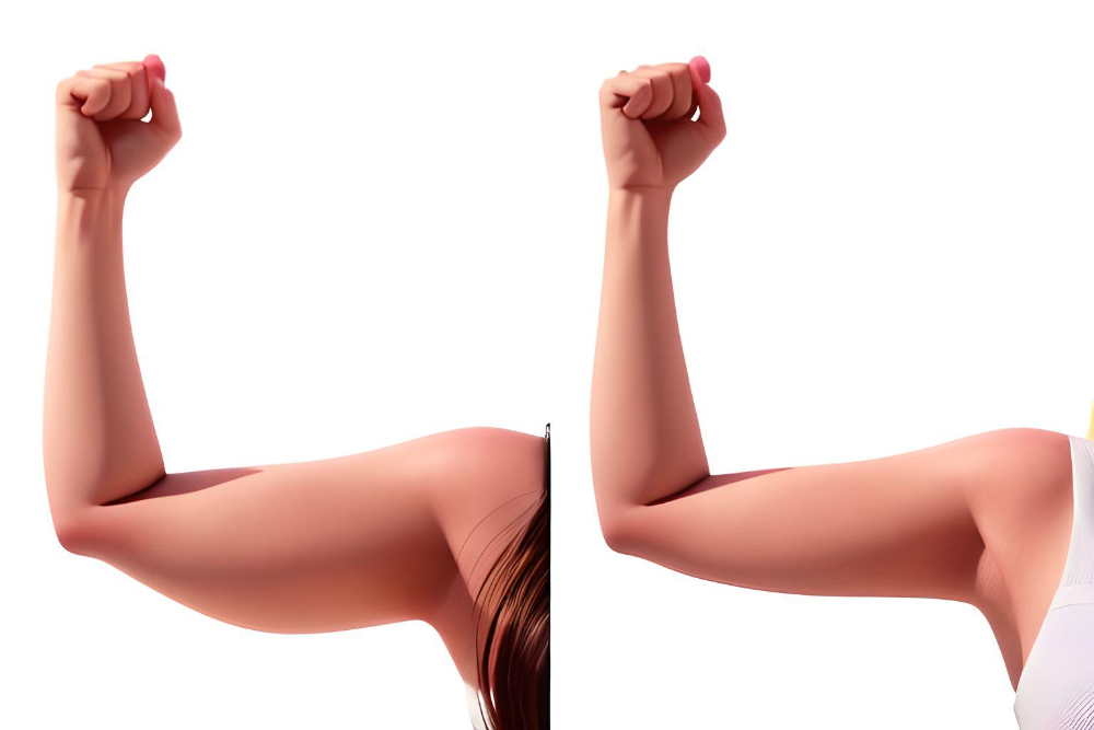 A woman's biceps before and after liposuction.