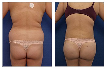 Back Contouring and BBL, suction-assisted liposuction of the abdomen, arms, axilla, lower/middle/upper back, medial thighs, knees, mini TT, bilateral axillary tucks