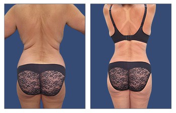 Back Contouring with Full Tummy Tuck, breast lift, HD VASER lipo of lower back, lateral thighs, BBL