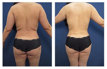 Back Contouring with HD VASER lipo of abdomen, flanks, lower, middle, upper back, with Brazilian Butt Lift