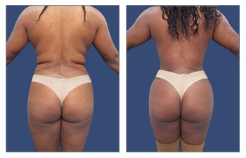 Back Contouring with HD VASER lipo of abdomen, flanks, lower,middle,upper back, fat grafting to the buttocks, BA