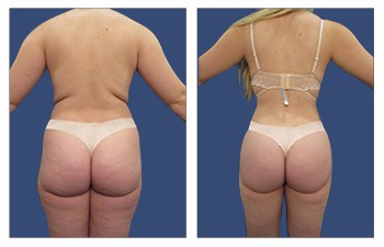 Back Contouring with High definition liposuction of the abdomen, lateral chest, flanks, medial thighs, lateral thighs, back, and fat grafting to the buttocks.