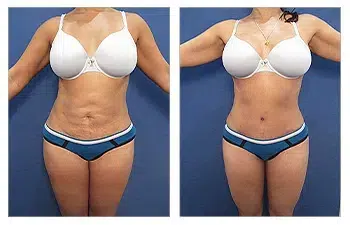 Before and after comparison of a botched liposuction Case 1