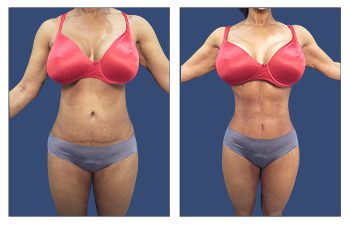 Botched Liposuction Before and after Case 2