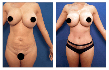 Before and after comparison of botched cosmetic surgery.