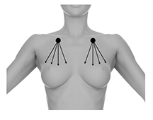 Upper Breast skin undergoing radiofrequency skin tightening.