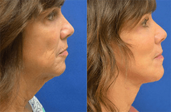 Side-by-side profile views of a woman showing Chin Lipo Before and After