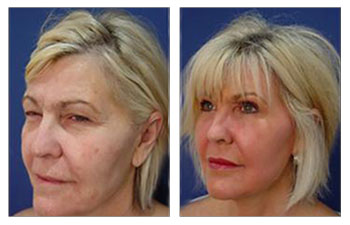 Chin and Neck Contouring with High defintiion liposuction