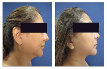Chin and Neck Contouring with hi-def lipo and Renuvion skin tightening.