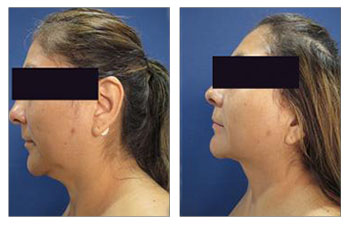 Chin and neck contouring with VASER lipo and Renuvion skin tightening