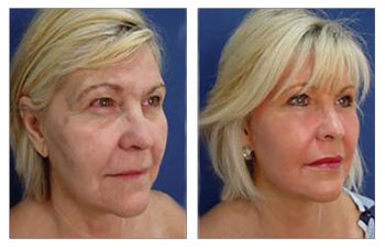 Chin and neck contouring with VASER liposuction and Renuvion skin tightening
