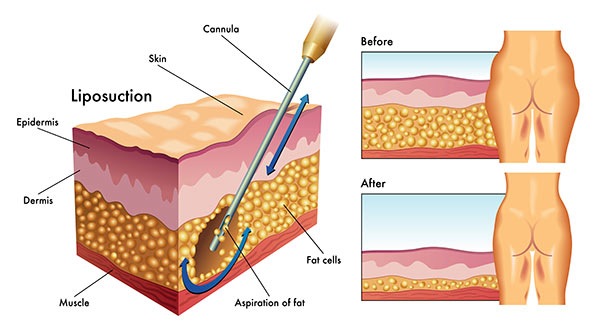The process of liposuction resulting in increase in skin redundancy