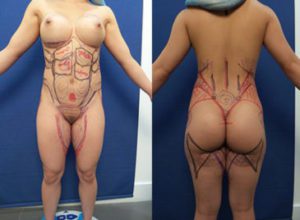 Female High Definition Liposuction Preoperative Markings
